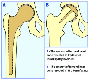 difference between hip surgery resurfacing replacment mcminn birmingham