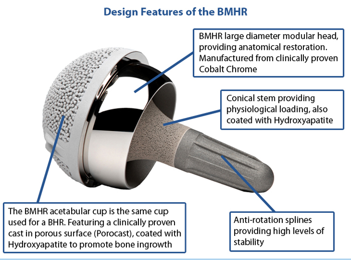 Design Features of the Birmingham Mid Head Resection (BMHR)