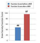Knee Function Score before and after a Birmingham Knee Replacement