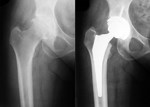 Osteoarthritic Hip Pre and Post Op with Conventional Uncemented Total Hip Replacement