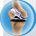 Knee Replacement