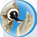 Total Hip Replacement