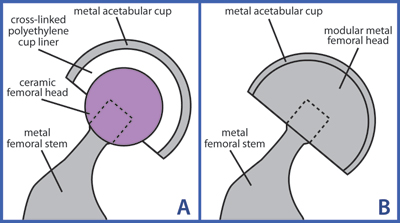 Total Hip Replacement