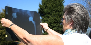 Maureen Berry - 40 year metal-metal hip replacement 2