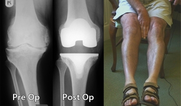 birmingham knee replacement x-ray