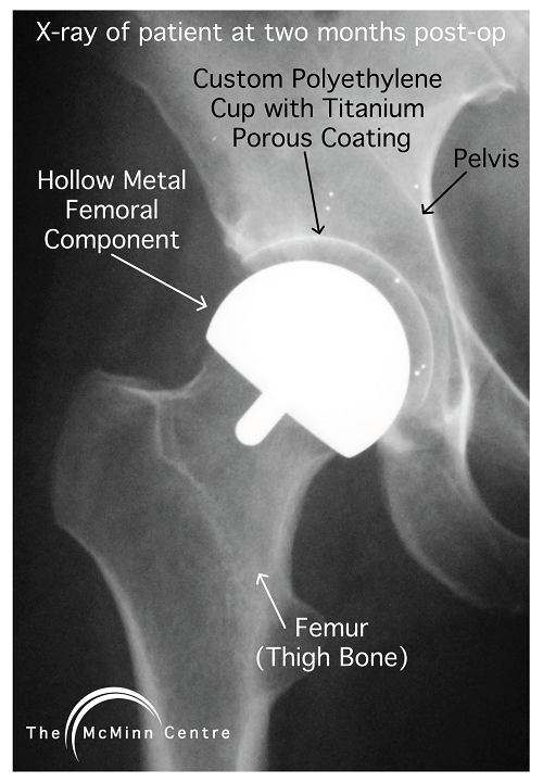 Custom Polyethylene Hip Resurfacing X-Ray