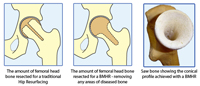 The Birmingham Mid Head Resection