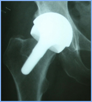 An X-ray showing a BMHR fitted with a ceramic head