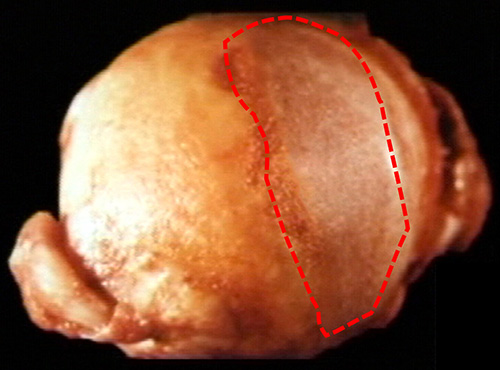 Femoral Head and Neck Removed at Total Hip Replacement showing Area of Cartilage Loss