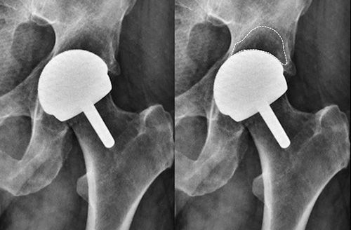 20 Years post BHR asymptomatic severe acetabular stress shielding