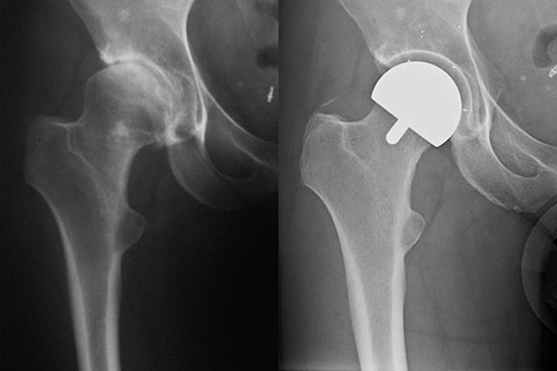 Pre and 2 Years Post Op MoX Resurfacing