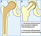 The Birmingham Hip Resurfacing