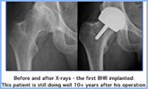 The Birmingham Hip Resurfacing