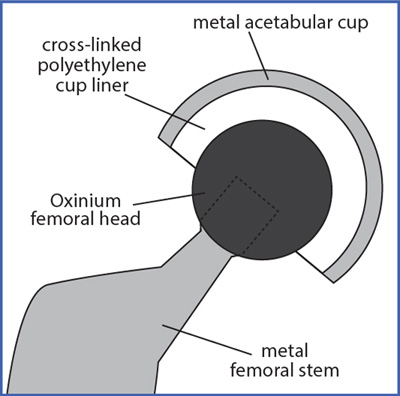 Total Hip Replacement