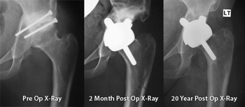 hip resurfacing x-rays 20 years