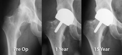 xray BHR Hip Resurfacing first patient