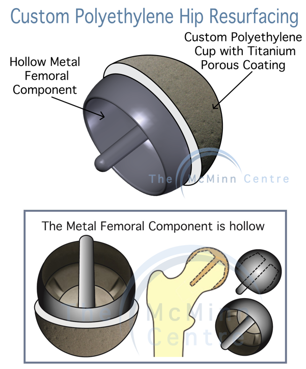 Custom Polyethylene Hip Resurfacing