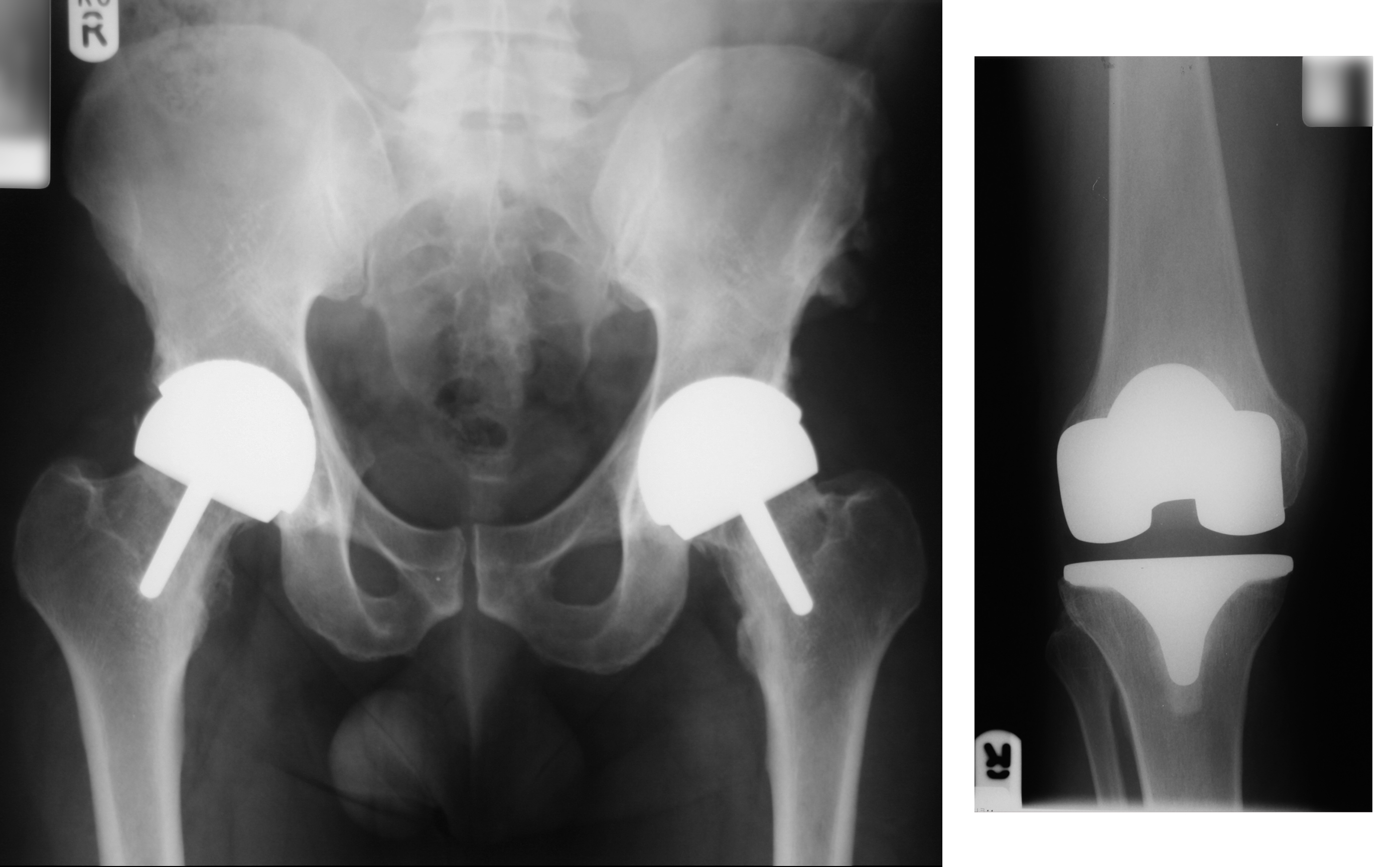 Wagner's Bilateral BHR x-ray (left) and BKR x-ray (right)